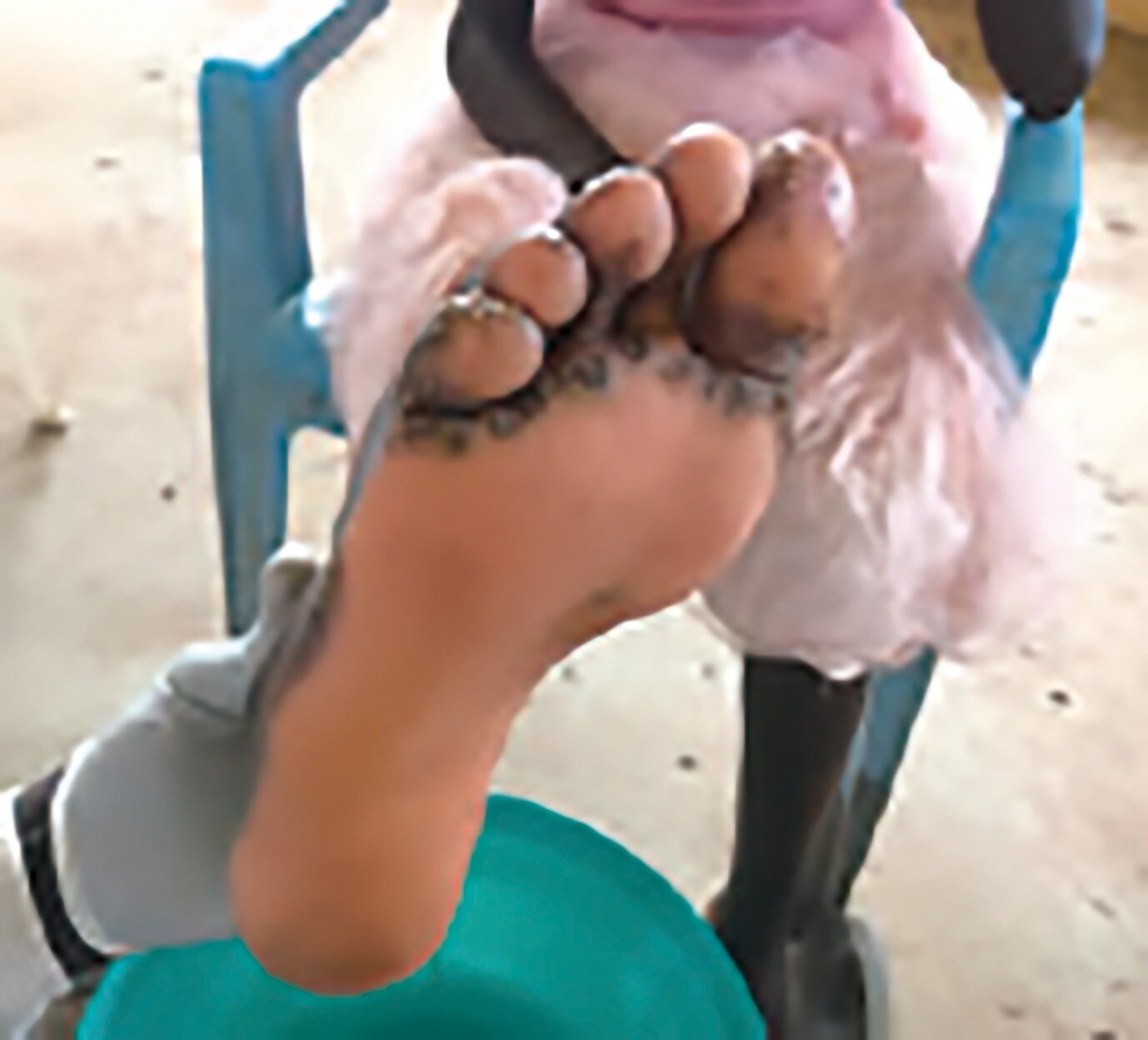 スナノミ症対策プロジェクト | 社会との関わり | サステナビリティ | サラヤ株式会社・東京サラヤ株式会社